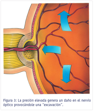 La presión elevada genera un daño en el nervio óptico provocándole una “excavación”.
